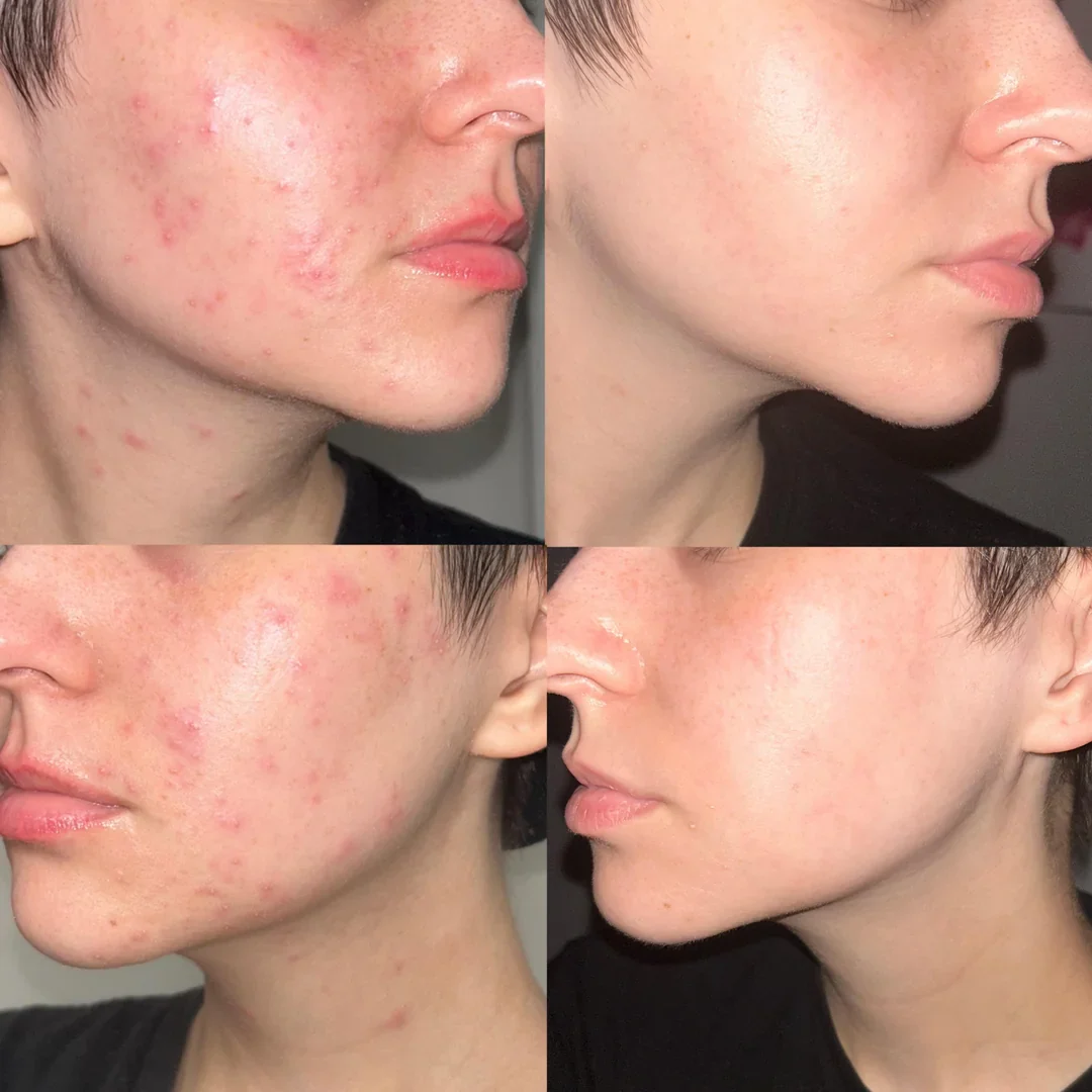 Before and after results with The Hydrocolloid Roll